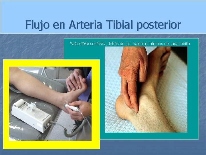 Flujo en Arteria Tibial posterior Pulso tibial posterior, detrás de los maléolos internos de