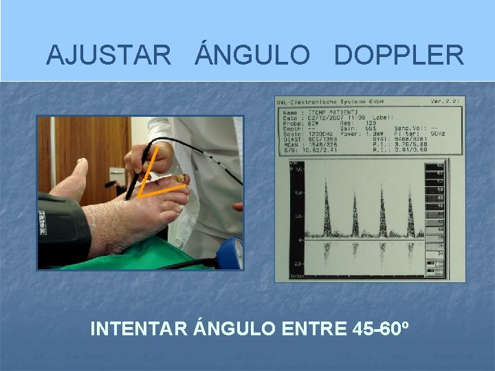 AJUSTAR ÁNGULO DOPPLER INTENTAR ÁNGULO ENTRE 45 -60º 