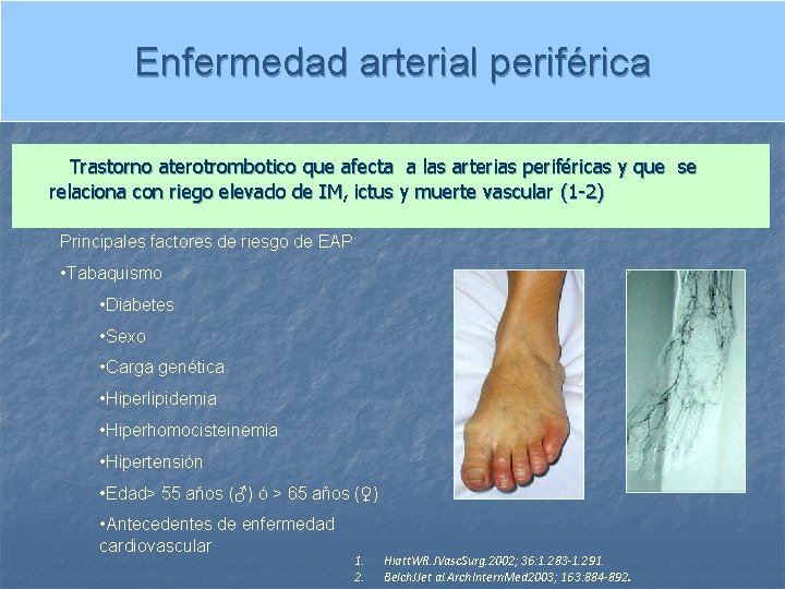 Enfermedad arterial periférica Trastorno aterotrombotico que afecta a las arterias periféricas y que se