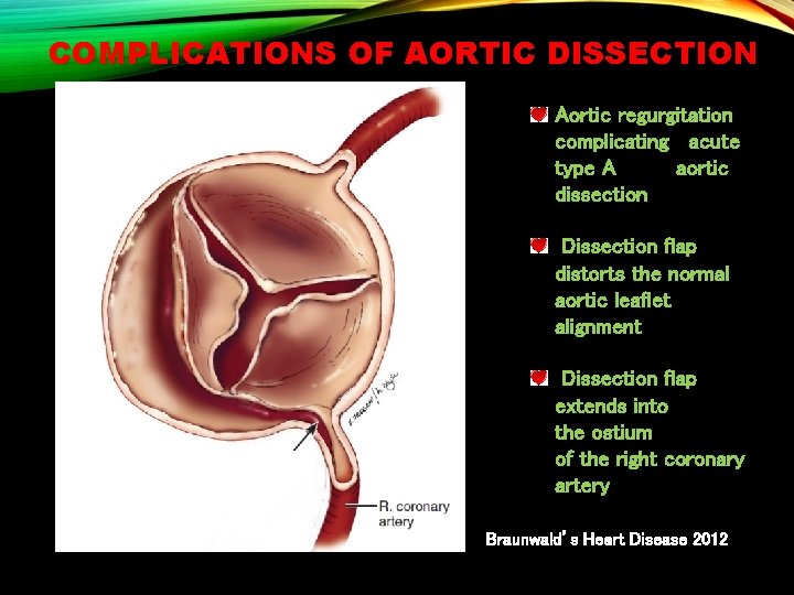 COMPLICATIONS OF AORTIC DISSECTION Aortic regurgitation complicating acute type A aortic dissection Dissection flap