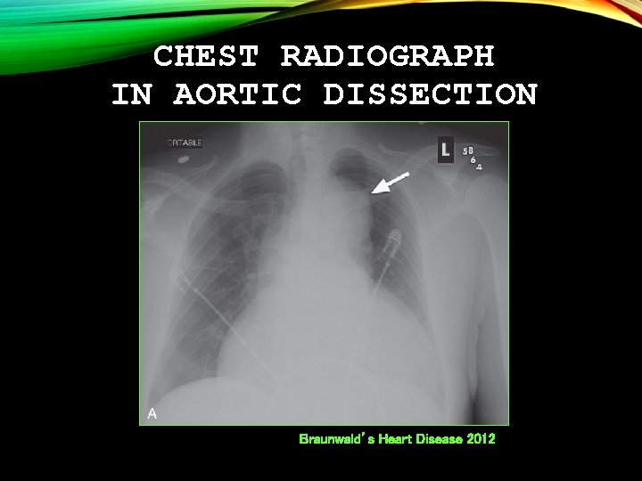 CHEST RADIOGRAPH IN AORTIC DISSECTION Braunwald’s Heart Disease 2012 
