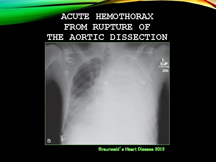 ACUTE HEMOTHORAX FROM RUPTURE OF THE AORTIC DISSECTION Braunwald’s Heart Disease 2012 