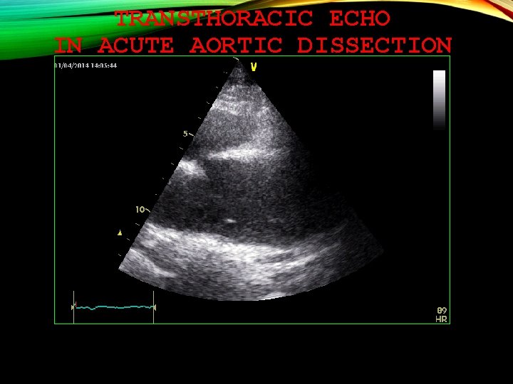 TRANSTHORACIC ECHO IN ACUTE AORTIC DISSECTION 