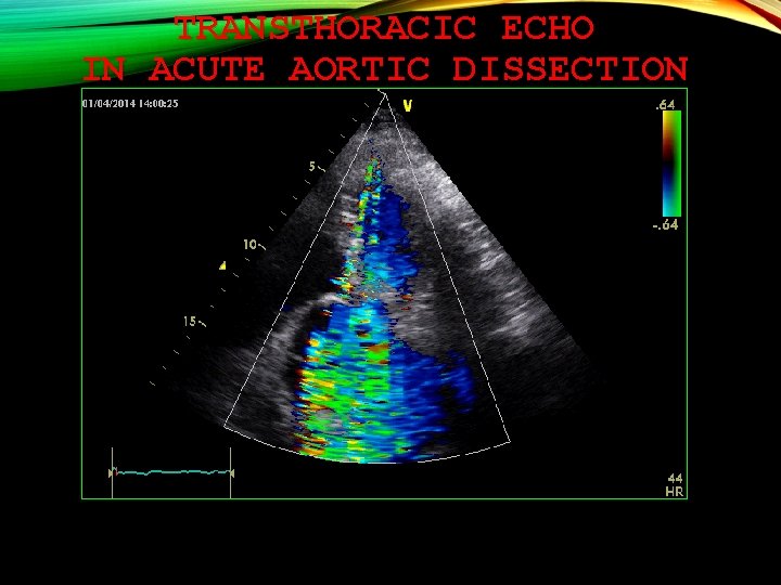TRANSTHORACIC ECHO IN ACUTE AORTIC DISSECTION 