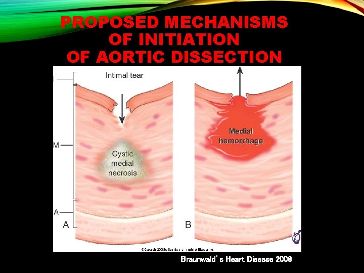 PROPOSED MECHANISMS OF INITIATION OF AORTIC DISSECTION Braunwald’s Heart Disease 2008 
