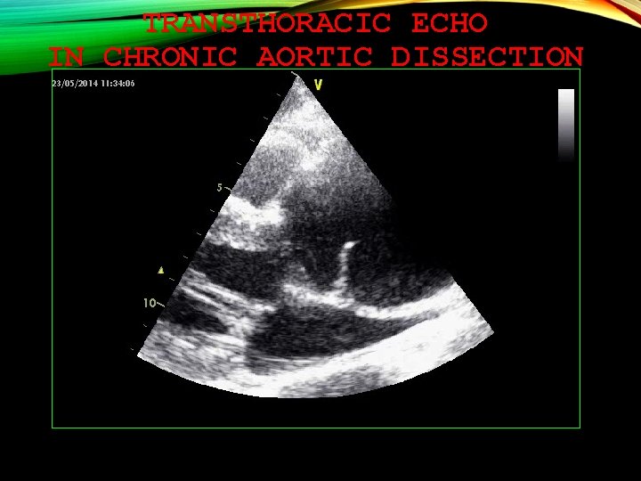 TRANSTHORACIC ECHO IN CHRONIC AORTIC DISSECTION 