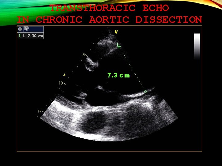 TRANSTHORACIC ECHO IN CHRONIC AORTIC DISSECTION 7. 3 cm 