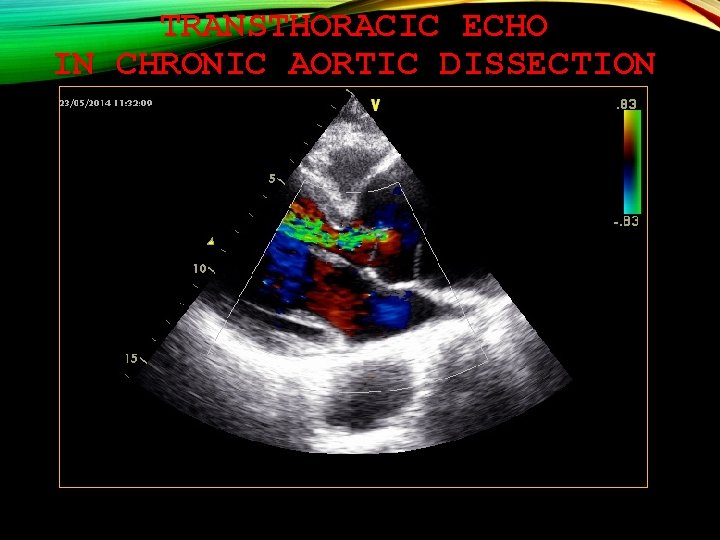 TRANSTHORACIC ECHO IN CHRONIC AORTIC DISSECTION 