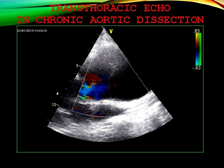 TRANSTHORACIC ECHO IN CHRONIC AORTIC DISSECTION 