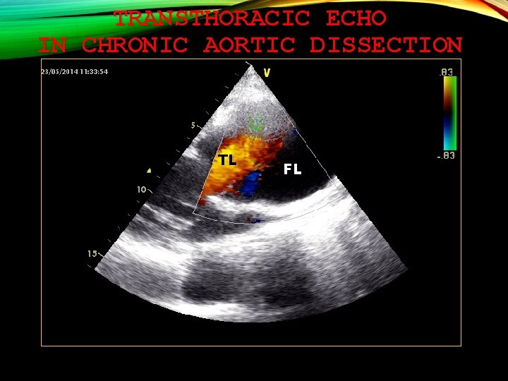 TRANSTHORACIC ECHO IN CHRONIC AORTIC DISSECTION TL FL 