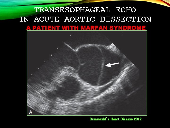 TRANSESOPHAGEAL ECHO IN ACUTE AORTIC DISSECTION A PATIENT WITH MARFAN SYNDROME Braunwald’s Heart Disease