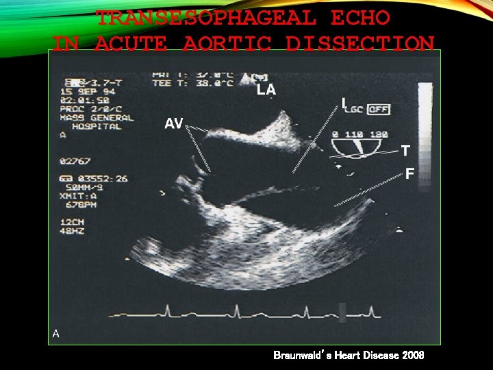 TRANSESOPHAGEAL ECHO IN ACUTE AORTIC DISSECTION Braunwald’s Heart Disease 2008 