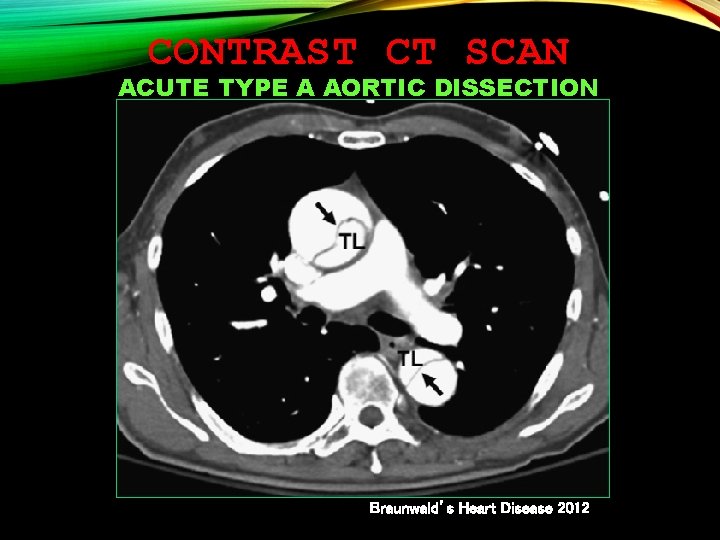 CONTRAST CT SCAN ACUTE TYPE A AORTIC DISSECTION Braunwald’s Heart Disease 2012 