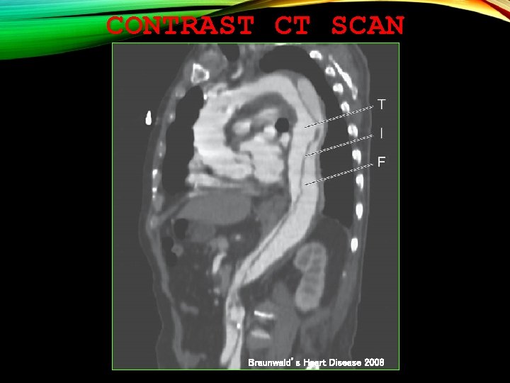 CONTRAST CT SCAN Braunwald’s Heart Disease 2008 