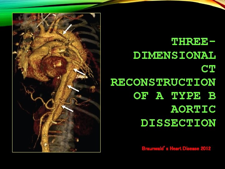 THREEDIMENSIONAL CT RECONSTRUCTION OF A TYPE B AORTIC DISSECTION Braunwald’s Heart Disease 2012 