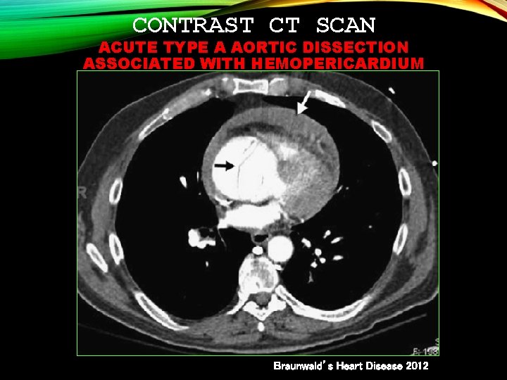 CONTRAST CT SCAN ACUTE TYPE A AORTIC DISSECTION ASSOCIATED WITH HEMOPERICARDIUM Braunwald’s Heart Disease