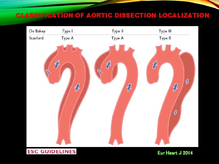 CLASSIFICATION OF AORTIC DISSECTION LOCALIZATION Eur Heart J 2014 