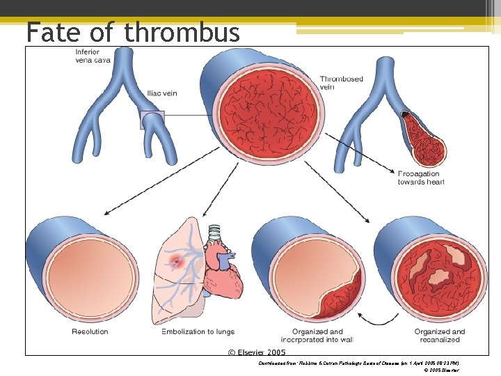 Fate of thrombus Downloaded from: Robbins & Cotran Pathologic Basis of Disease (on 1