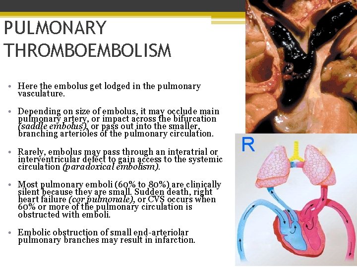 PULMONARY THROMBOEMBOLISM • Here the embolus get lodged in the pulmonary vasculature. • Depending