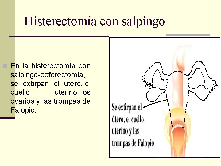 Histerectomía con salpingo n En la histerectomía con salpingo-ooforectomía, se extirpan el útero, el