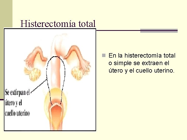 Histerectomía total n En la histerectomía total o simple se extraen el útero y