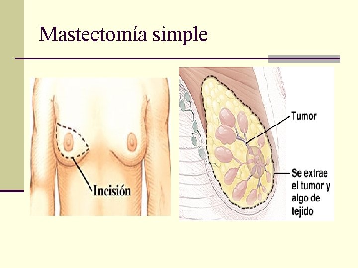 Mastectomía simple 