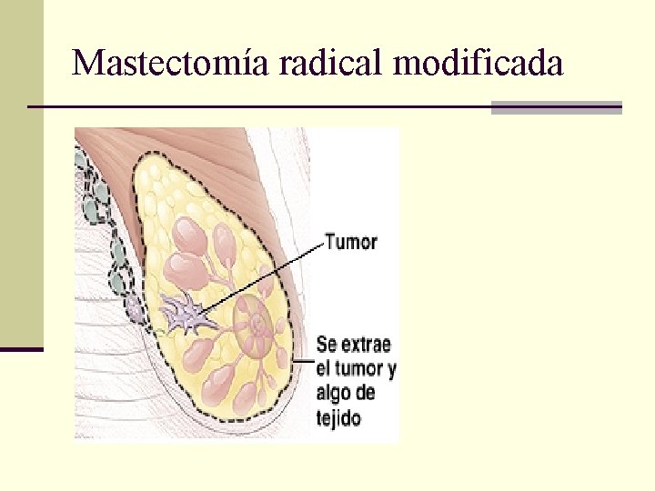 Mastectomía radical modificada 