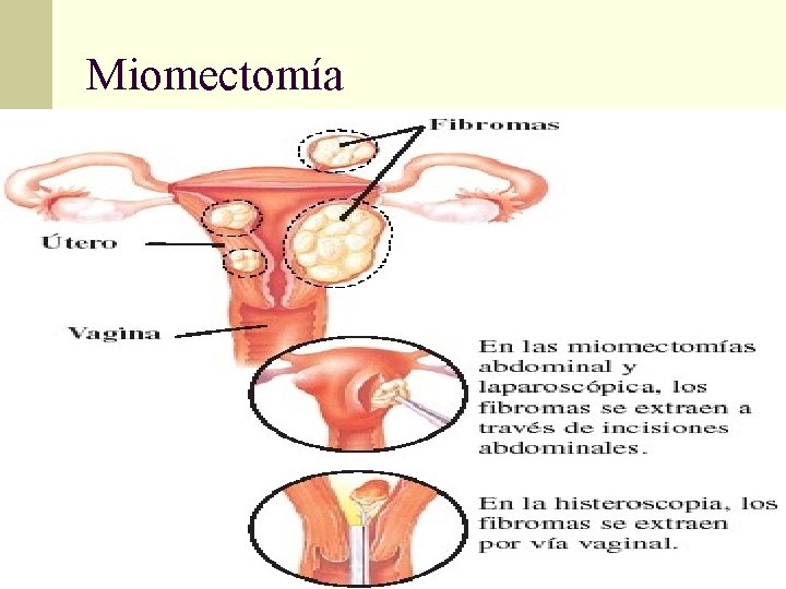 Miomectomía 