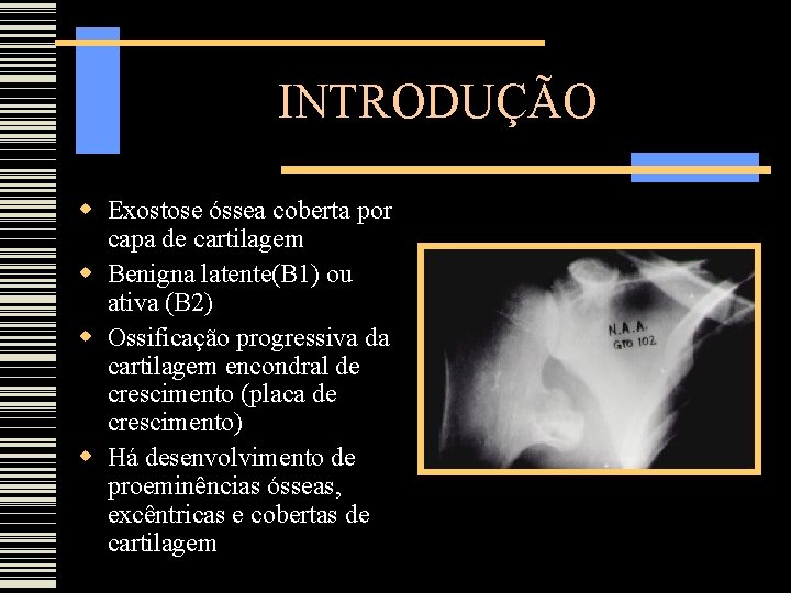 INTRODUÇÃO Exostose óssea coberta por capa de cartilagem Benigna latente(B 1) ou ativa (B