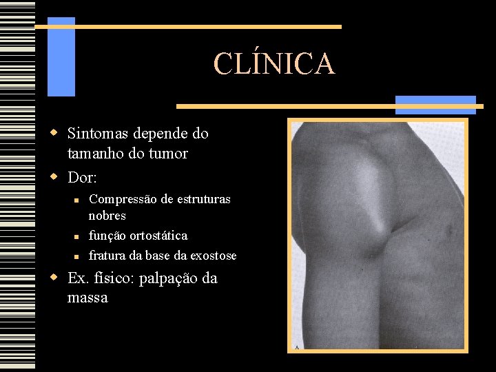 CLÍNICA Sintomas depende do tamanho do tumor Dor: Compressão de estruturas nobres função ortostática