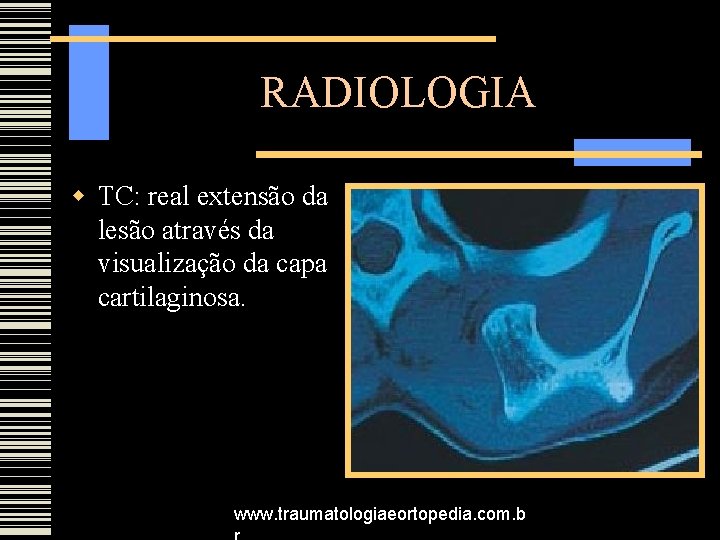 RADIOLOGIA TC: real extensão da lesão através da visualização da capa cartilaginosa. www. traumatologiaeortopedia.