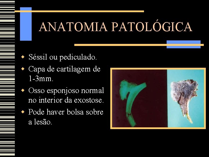 ANATOMIA PATOLÓGICA Séssil ou pediculado. Capa de cartilagem de 1 -3 mm. Osso esponjoso