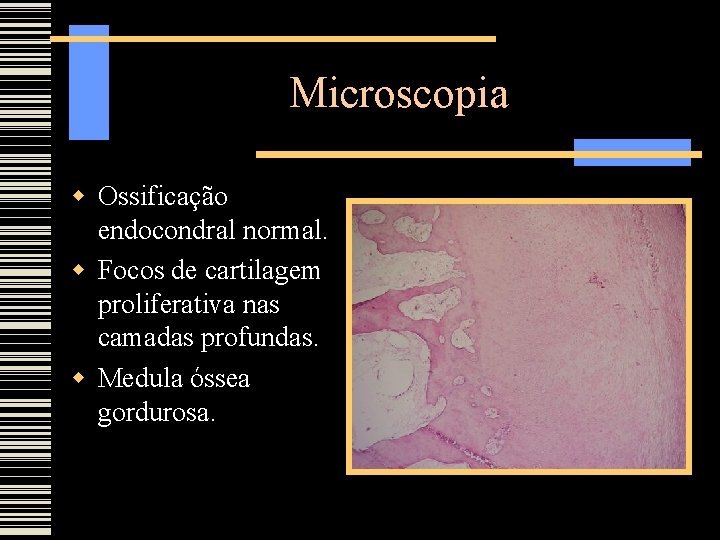 Microscopia Ossificação endocondral normal. Focos de cartilagem proliferativa nas camadas profundas. Medula óssea gordurosa.