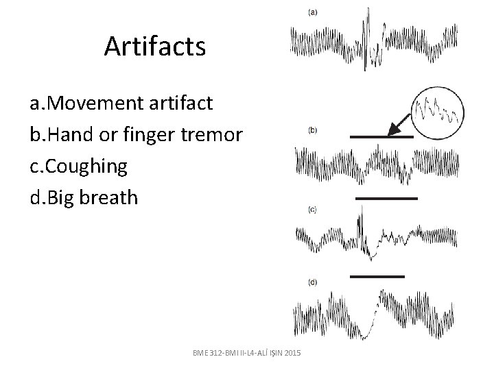 Artifacts a. Movement artifact b. Hand or finger tremor c. Coughing d. Big breath