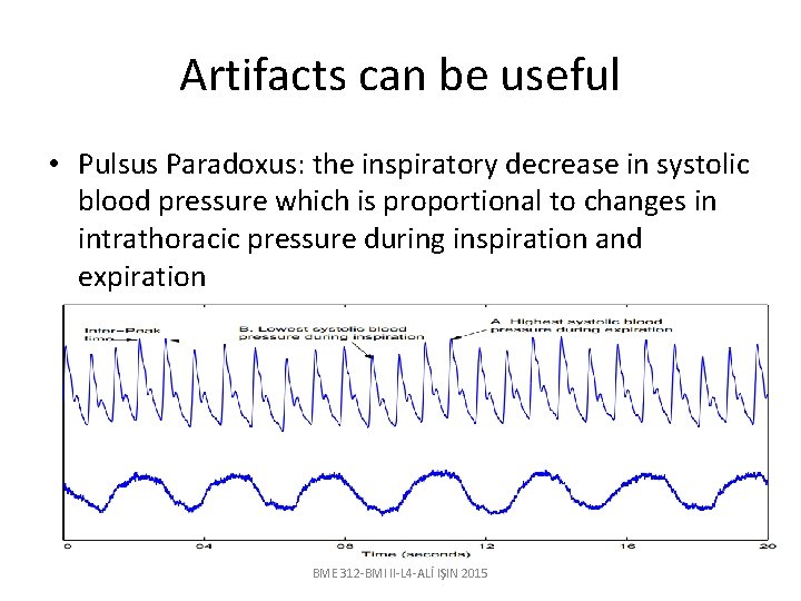 Artifacts can be useful • Pulsus Paradoxus: the inspiratory decrease in systolic blood pressure