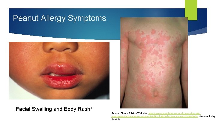 Peanut Allergy Symptoms Facial Swelling and Body Rash 7 Source: Clinical Advisor Web site.