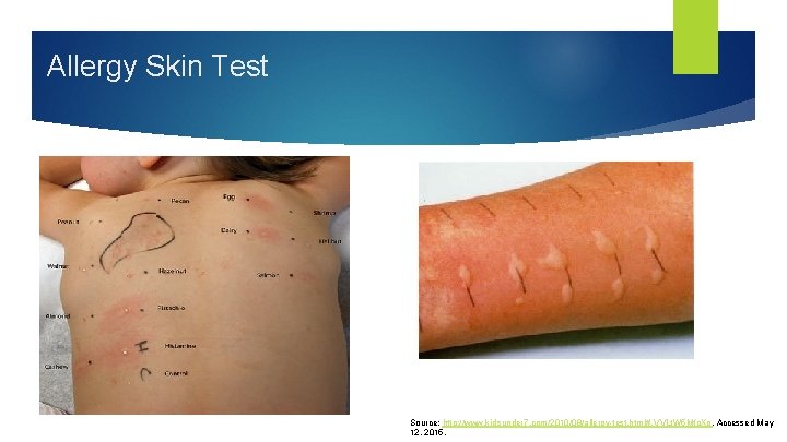 Allergy Skin Test Source: http: //www. kidsunder 7. com/2010/08/allergy-test. html#. VVLt. W 5 Mfo.