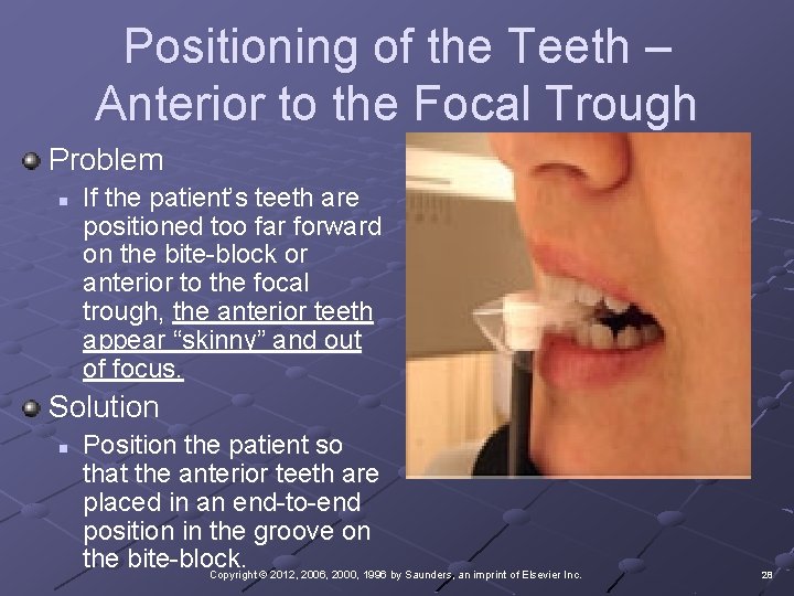 Positioning of the Teeth – Anterior to the Focal Trough Problem n If the