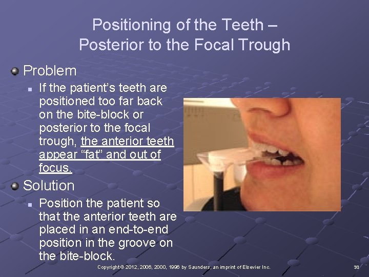 Positioning of the Teeth – Posterior to the Focal Trough Problem n If the