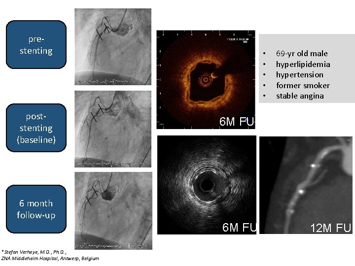 prestenting poststenting (baseline) • • • 69 -yr old male hyperlipidemia hypertension former smoker prestenting poststenting (baseline) • • • 69 -yr old male hyperlipidemia hypertension former smoker