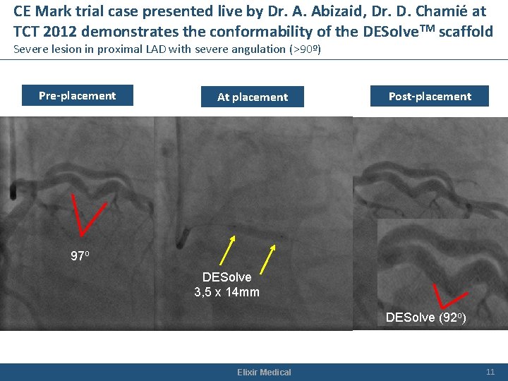 CE Mark trial case presented live by Dr. A. Abizaid, Dr. D. Chamié at CE Mark trial case presented live by Dr. A. Abizaid, Dr. D. Chamié at
