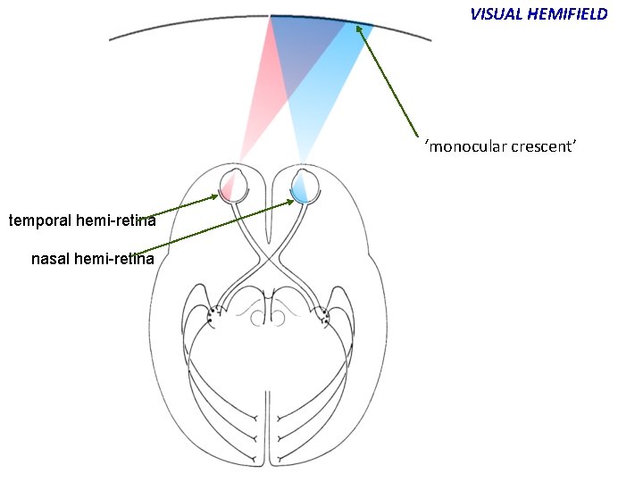VISUAL HEMIFIELD ‘monocular crescent’ temporal hemi-retina nasal hemi-retina 