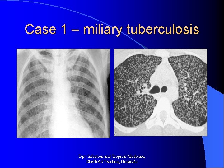 Case 1 – miliary tuberculosis Dpt. Infection and Tropical Medicine, Sheffield Teaching Hospitals 