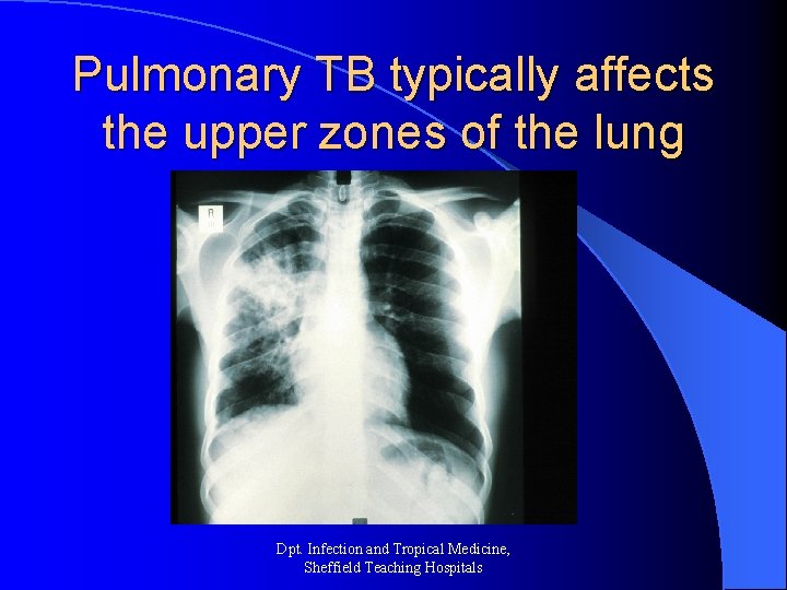 Pulmonary TB typically affects the upper zones of the lung Dpt. Infection and Tropical