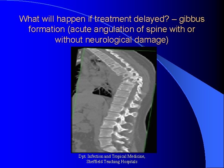 What will happen if treatment delayed? – gibbus formation (acute angulation of spine with