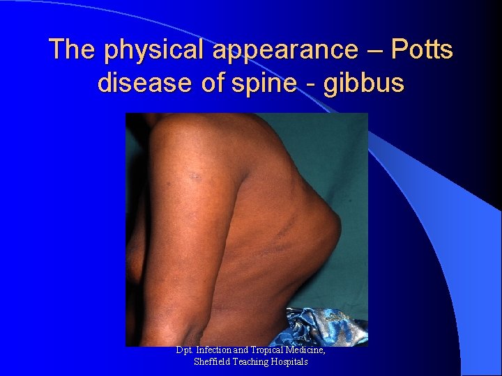 The physical appearance – Potts disease of spine - gibbus Dpt. Infection and Tropical