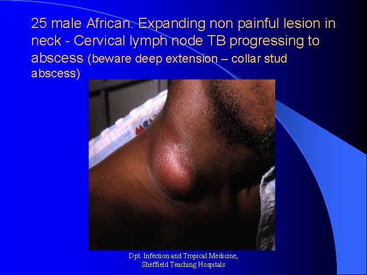 25 male African. Expanding non painful lesion in neck - Cervical lymph node TB