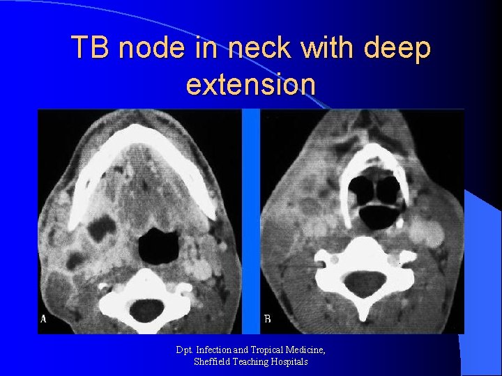 TB node in neck with deep extension Dpt. Infection and Tropical Medicine, Sheffield Teaching