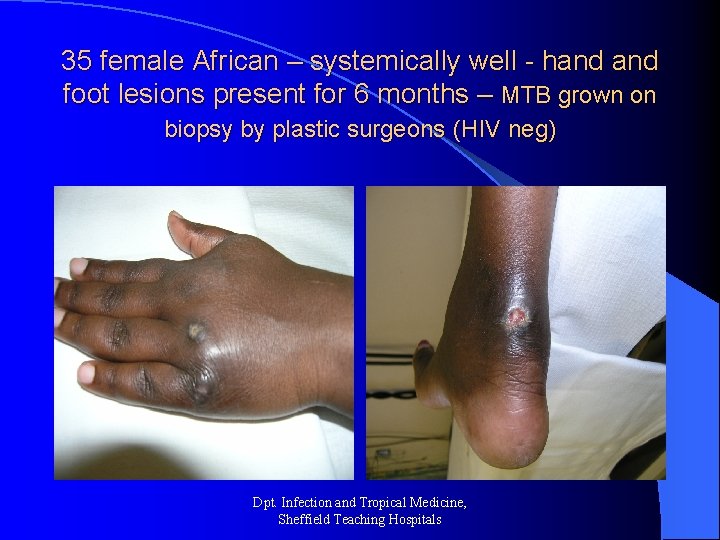 35 female African – systemically well - hand foot lesions present for 6 months