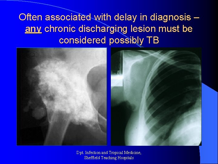 Often associated with delay in diagnosis – any chronic discharging lesion must be considered